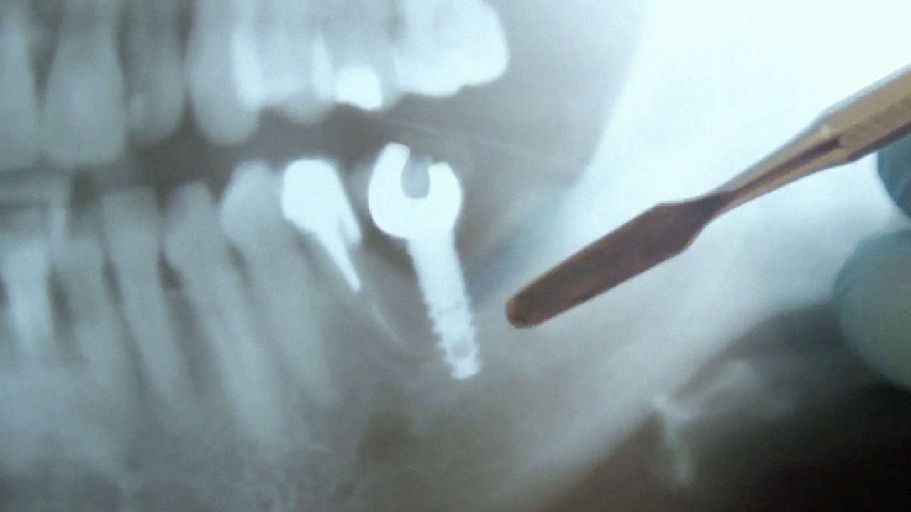 A Beer Brand Replaced Rugby Players’ Missing Teeth With Implanted