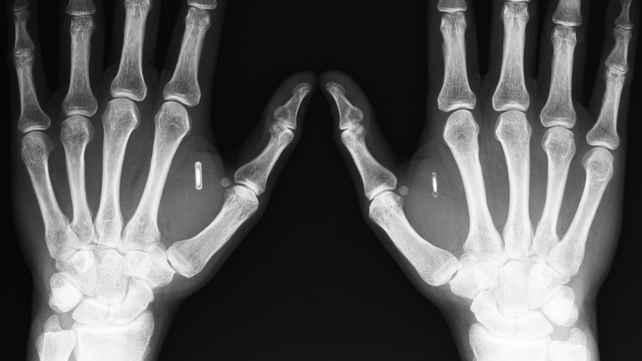 Under My Skin The New Frontier Of Digital Implants Fast Company